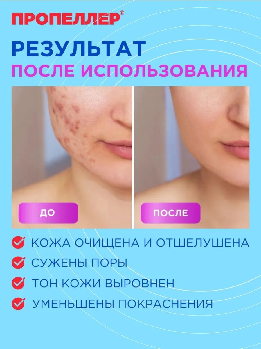 Пропеллер Салициловый лосьон от прыщей для жирной кожи 100мл